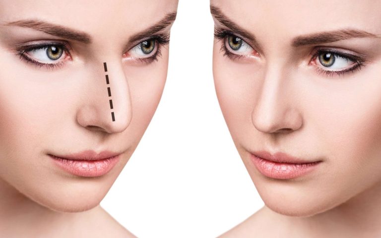 La rhinoplastie, une solution pour avoir un nez parfait !