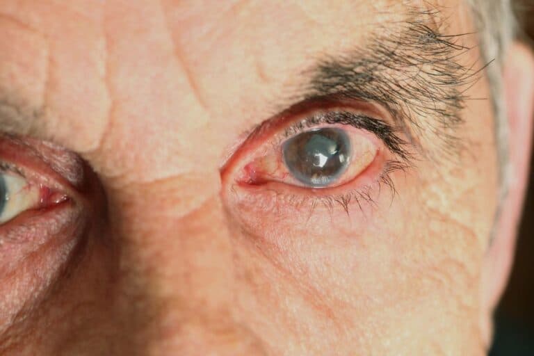 Comment traiter le glaucome chez les seniors ? 