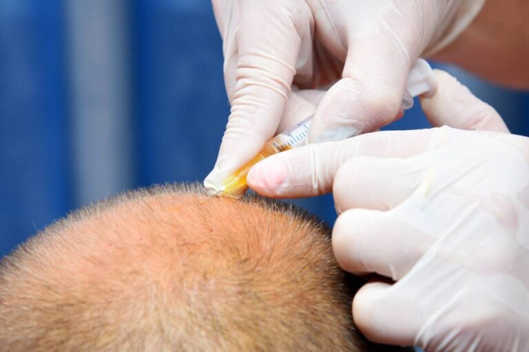 Greffe de cheveux pour les seniors : Quand et pourquoi envisager cette option ? Greffe de cheveux pour les seniors : Quand et pourquoi envisager cette option ?